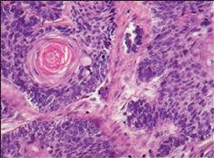 Follicles showed varying histologic features like nuclear polymorphism, basal cell hyperplasia, squamous metaplasia with dyskeratosis, necrosis, and cystic degeneration.