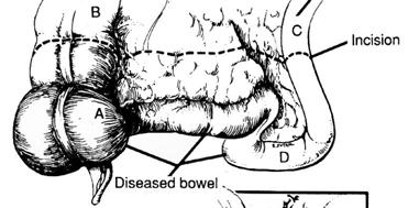 Small Bowel Disease Management Issues Tends to be