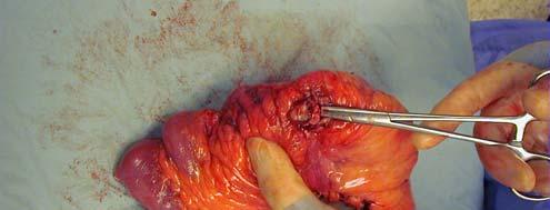 Surgical Treatment of Intraabdominal Fistulas Resect