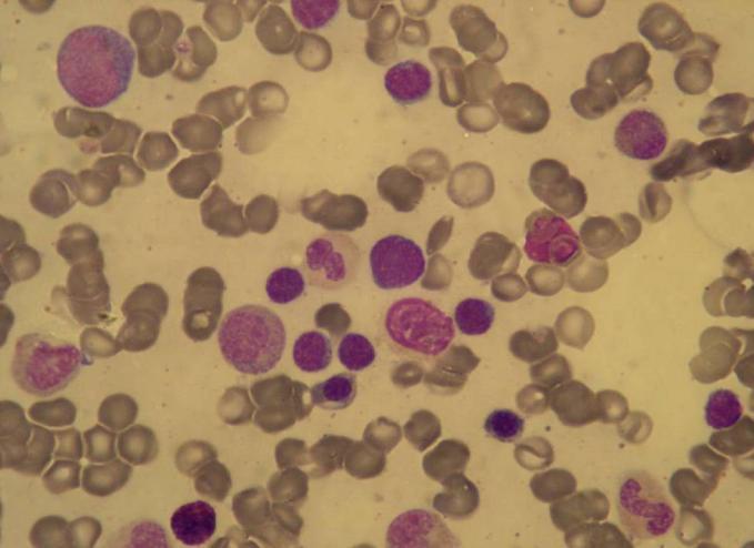 Blastic NK-cell lymphoma.