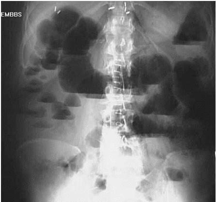 Complications of Fistula formation up to 40% of patients Enteroenteric Enterovesicular recurrent UTIs and pneumaturia Enterocutaneous rectovaginal, fistula in ano Perianal abscesses Intra abdominal