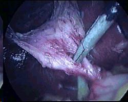 Injury by Instruments The maryland dissector has a convex border as the Cystic artery is just