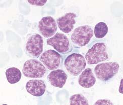Meda et al / DIAGNOSIS AND SUBCLASSIFICATION OF PRIMARY AND RECURRENT LYMPHOMA Image 1 Chronic lymphocytic leukemia.