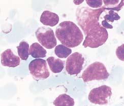A mixed population of small cleaved and large cleaved lymphocytes, each constituting approximately 50% of the malignant population (Romanowsky, 1,000). Image 4 Follicle center lymphoma, grade III.
