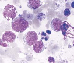 Several lymphoglandular bodies are also present (Romanowsky, 1,000). Image 8 Burkitt-like lymphoma.