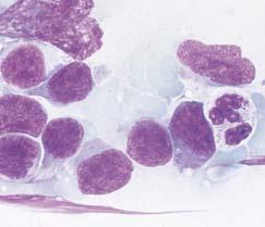 Anatomic Pathology / ORIGINAL ARTICLE Image 9 Peripheral T-cell lymphoma, unspecified.