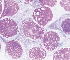 Occasional scattered epithelioid histiocytes were also seen (Romanowsky, 1,000). Image 10 Anaplastic large cell (CD30+) lymphoma.