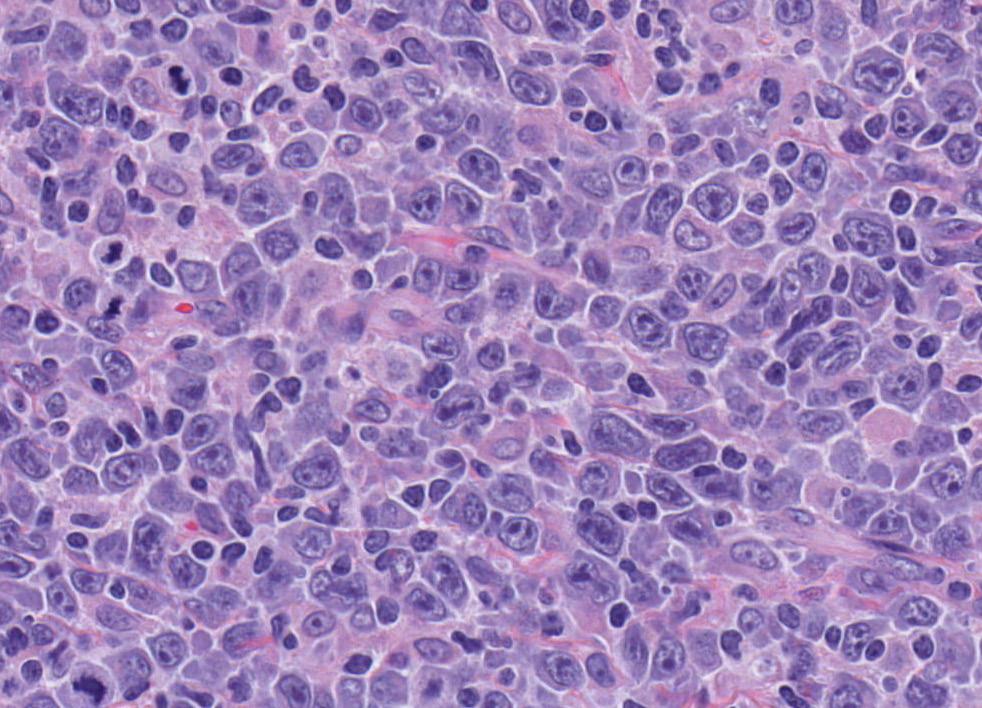 10 Hematopathology diagnostic solutions Diffuse large B-cell lymphoma DLBCL can arise in follicular lymphoma, CLL/SLL, or marginal zone lymphoma.