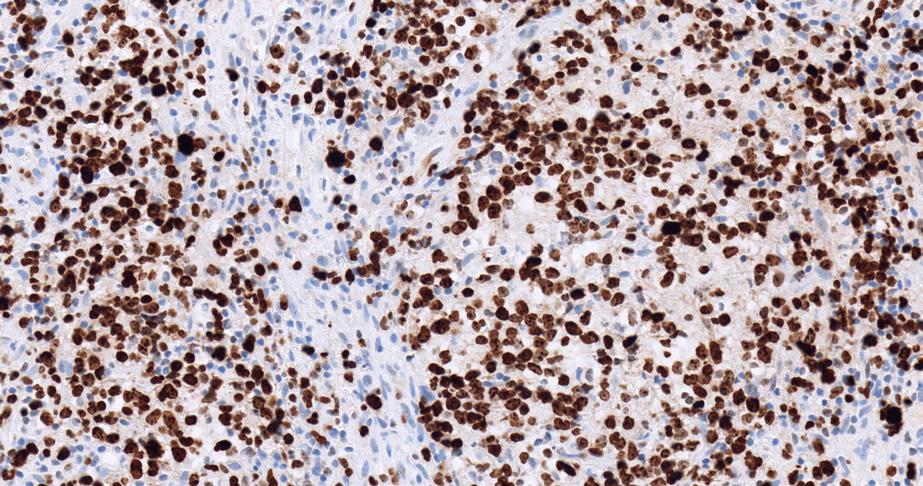 large cell lymphoma. DLBCL, NOS can also mimic metastatic carcinoma and melanoma.12 15 Key markers that aid diagnosis DLBCLs express pan-b-cell markers such as CD19, CD20 (Figure 7a) and CD79a.