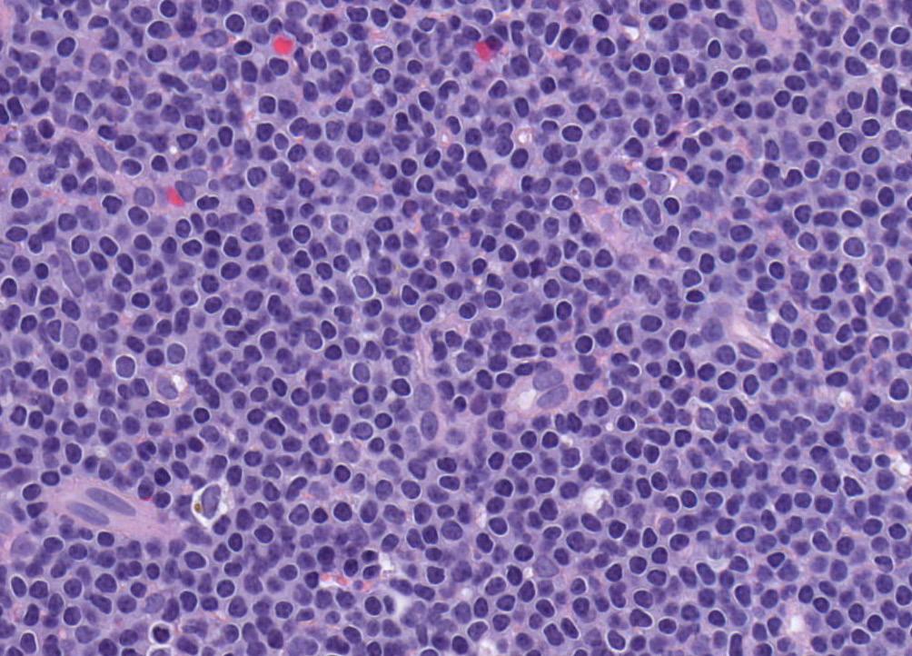 12 Hematopathology diagnostic solutions Chronic lymphocytic leukemia/ small lymphocytic lymphoma immunophenotyping may be required to establish a diagnosis of CLL when the absolute lymphocyte count