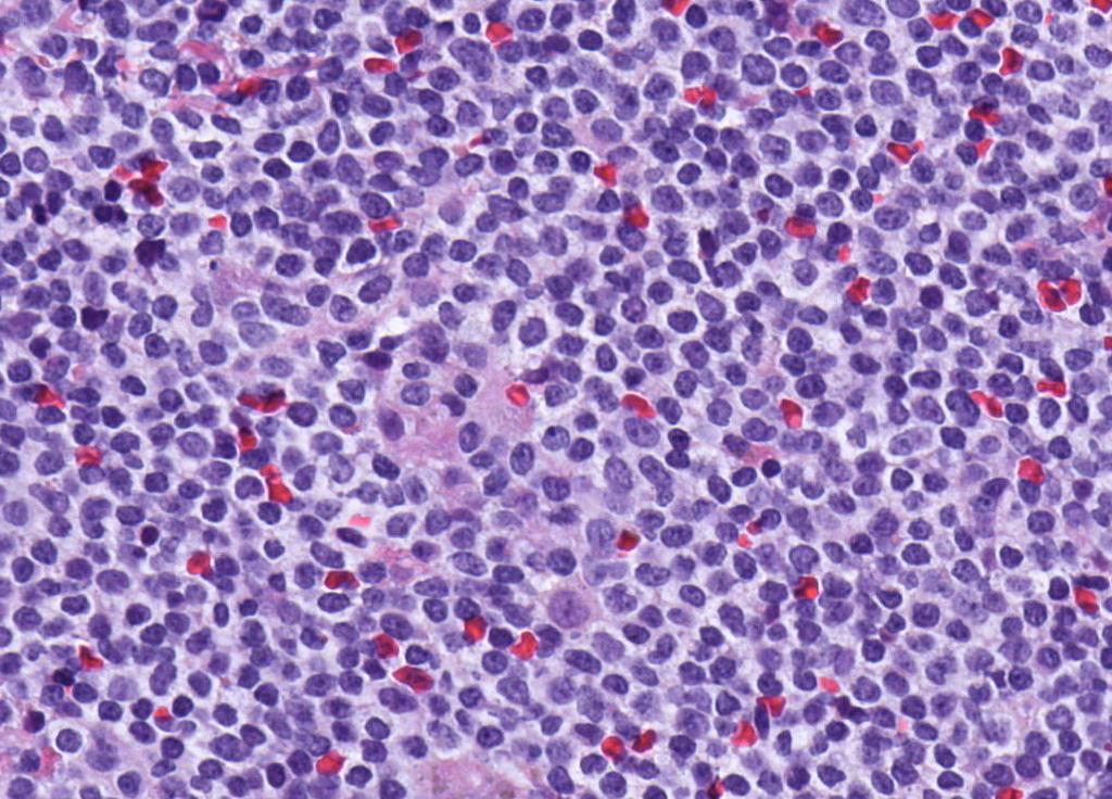 14 Hematopathology diagnostic solutions Mantle cell lymphoma.