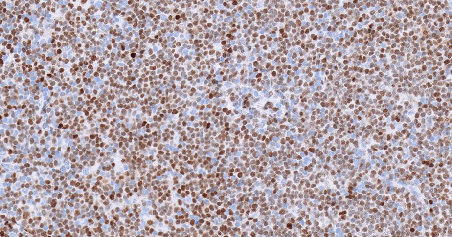 Hematopathology diagnostic solutions 15 Key markers that aid diagnosis CCND1 translocation is characteristic of this lymphoma