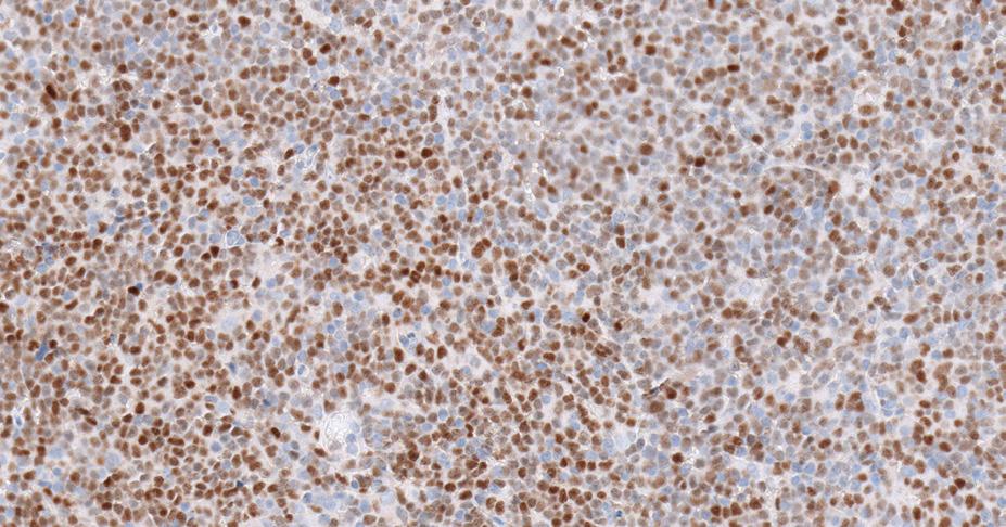 7). A rare subset of mantle cell lymphomas are Cyclin D1 negative and SOX11 positive (Figure 14).