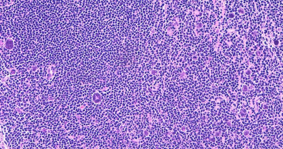 2 Hodgkin lymphomas are classified into two main types: classical Hodgkin lymphoma (CHL) comprises 90-95% of cases and nodular lymphocyte predominant Hodgkin lymphoma (NLPHL) comprises 5-10% (Figures
