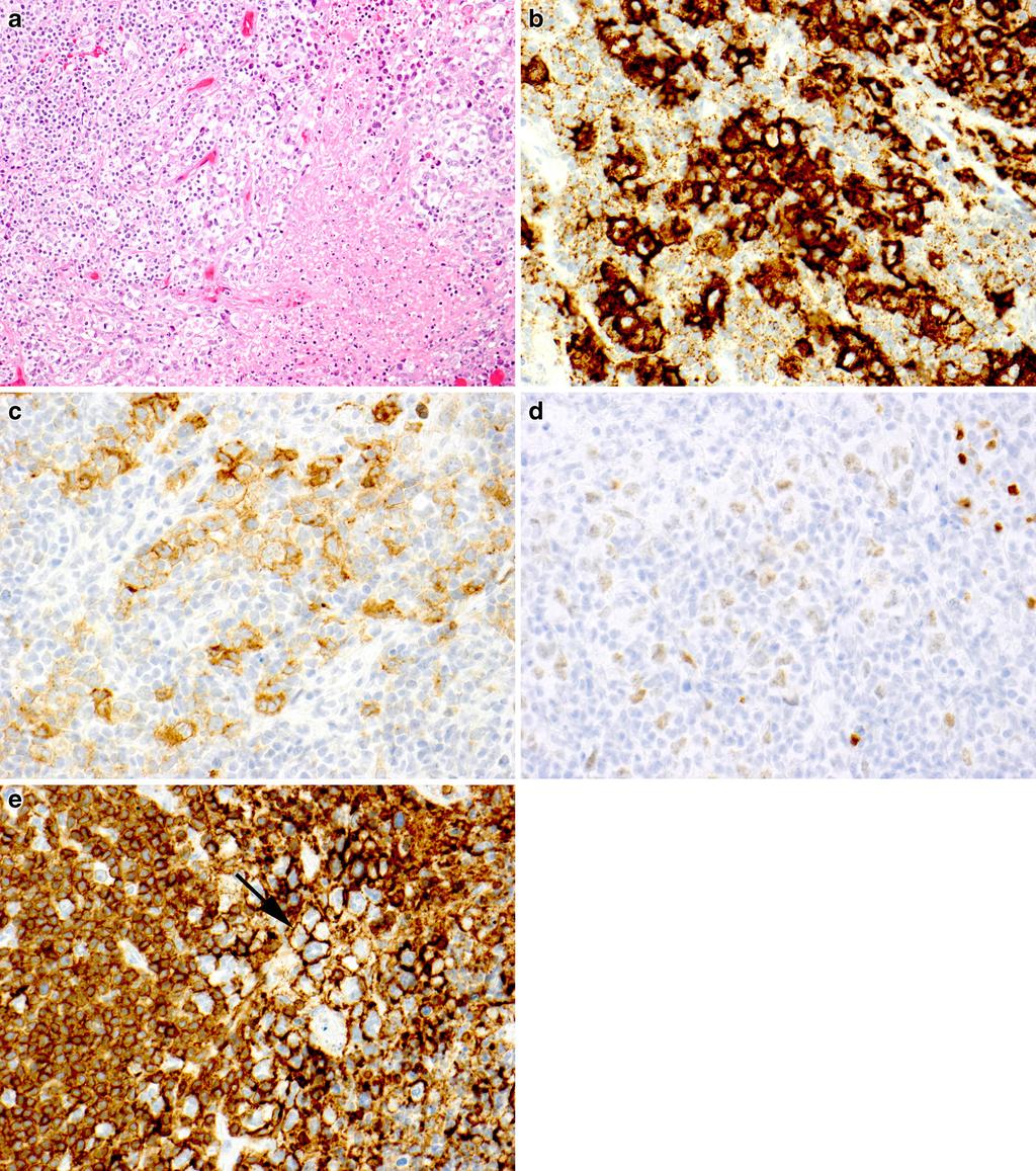 J Hematopathol (2014) 7:123 138 129 Fig. 2 Nodular sclerosis classical Hodgkin lymphoma with T antigen expression.