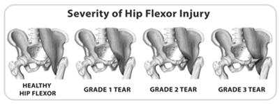 HIP FLEXOR STRAIN Generic term Simple muscle/tendon/ligament strain Most common cause of groin pain in athletic population Conservative treatment with relative rest, rehab ILIOPSOAS BURSITIS Lies