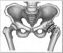 OSTEOARTHRITIS Gradual onset of pain Pain in groin Wearing/loss of articular cartilage leads to degenerative changes