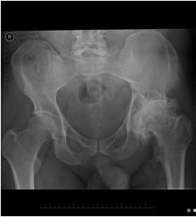 Radiographs show narrowing joint line, bone spur formation, cystic changes