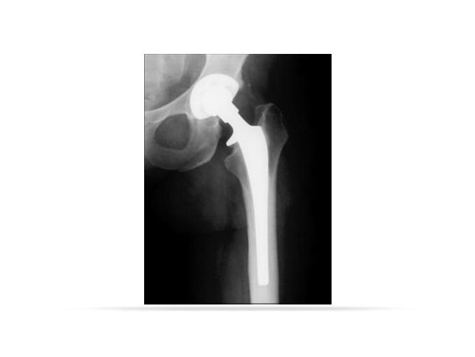 for strengthening, mobility evaluation in elderly May consider intraarticular