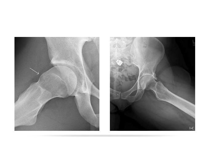 HIP DYSPLASIA From Ancient Greek dys-, bad and plasis, formation Congenital defect Acetabulum does not completely cover the femoral head, creating increased force that is