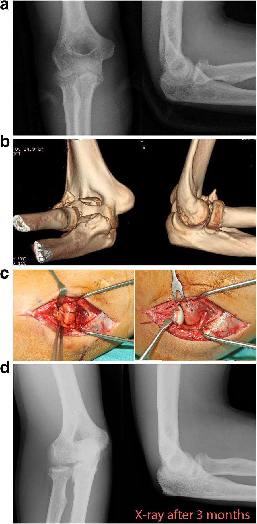 Tarallo et al. BMC Musculoskeletal Disorders (2018) 19:94 Page 2 of 7 mini-screws) in patients with Mason type II and III radial head fracture.