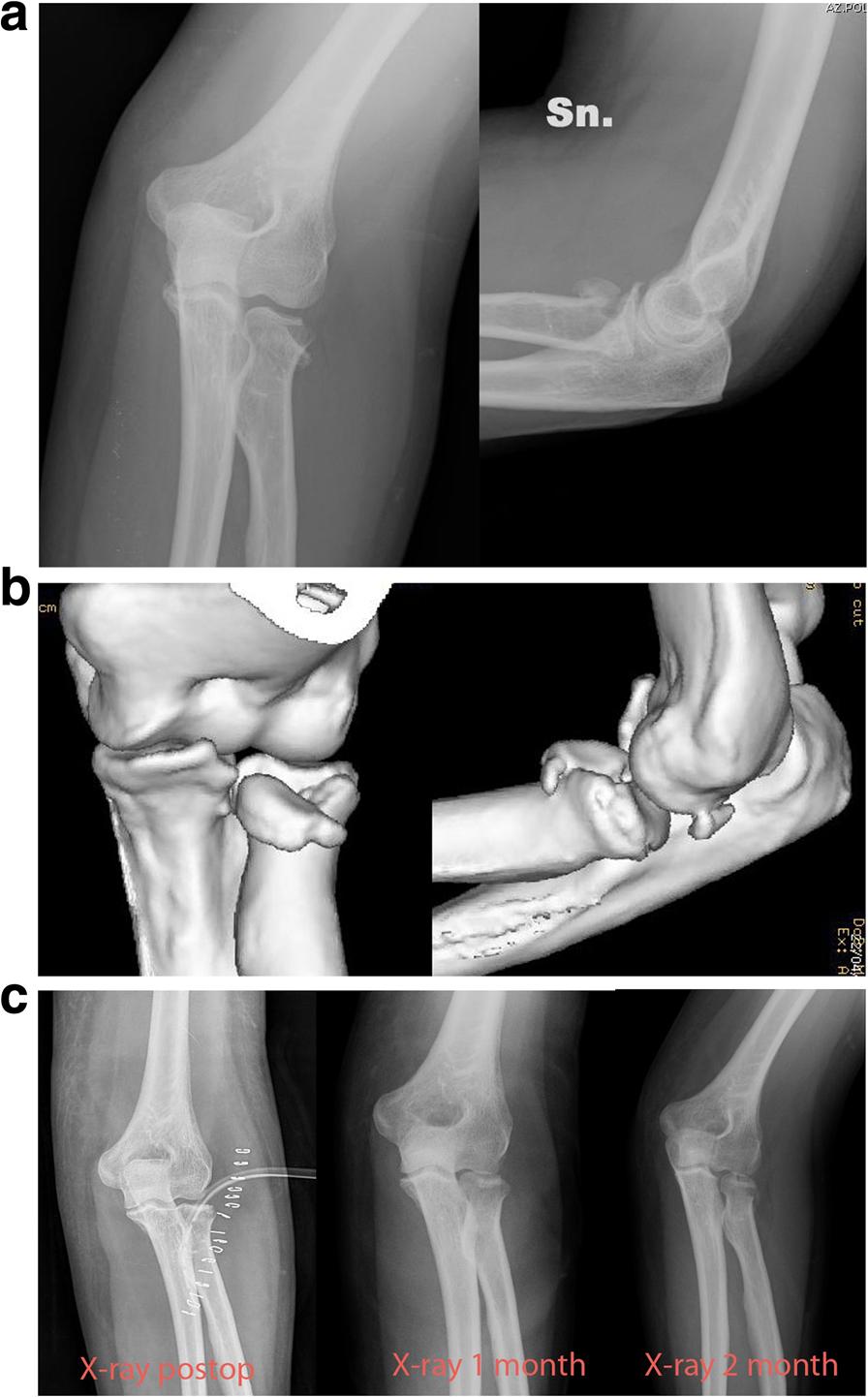 Tarallo et al. BMC Musculoskeletal Disorders (2018) 19:94 Page 5 of 7 Fig. 3 a Severely displaced Mason type II fracture. b 3D-computed tomography study.