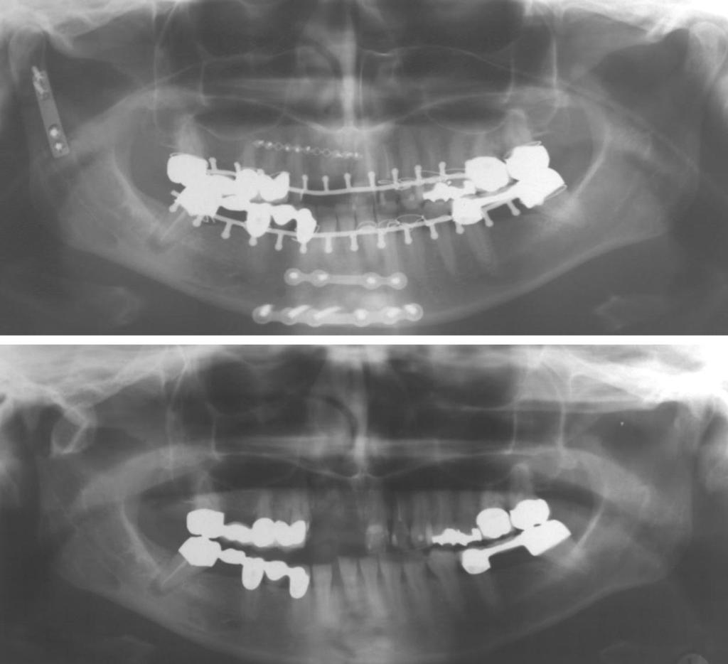 reduction and osteosynthesis. Maxillomandibular fixation was used intraoperatively for the osteosynthesis of an additional mandibular fracture. FIG. 2. Same patient as shown in Figure 1.