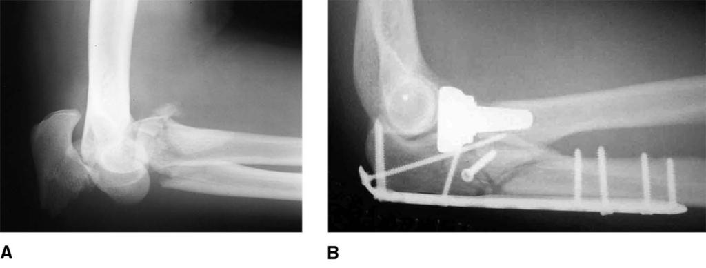 John D. Wyrick, MD, et al Figure 2 Figure 3 Preoperative (A) and postoperative (B) lateral radiographs demonstrating a transolecranon fracture-dislocation. repair in the early stages of healing.