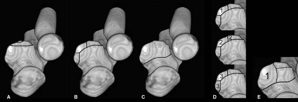 John D. Wyrick, MD, et al Figure 5 O Driscoll classification of coronoid fractures. A, Type I, fracture of the tip of the coronoid. B, Type II, fracture of the anteromedial (AM) facet.