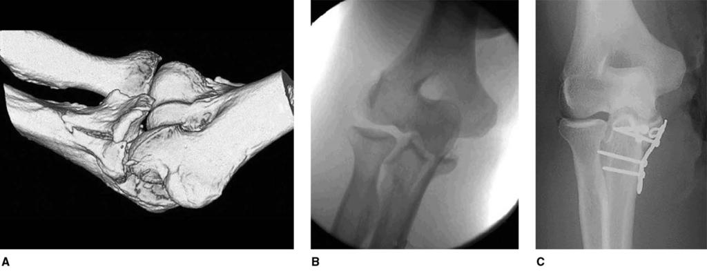 Figure 9 Intraoperative photograph demonstrates open reduction and internal fixation of anteromedial facet fracture. C = coronoid, M = medial epicondyle of the humerus.