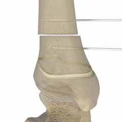 Complete the metaphyseal osteotomy 2.0-2.