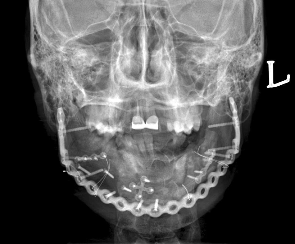 5) Reconstruction of the mandible continuity and rehabilitation of oral functions like dieting and mouth opening recovered without significant complications.