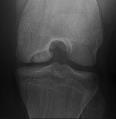 12/18/2017 Osteochondritis Dissecans (OCD) of the Knee Drilling Indications & Techniques Matthew D.