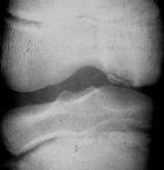 Knee Osteochondritis Dissecans