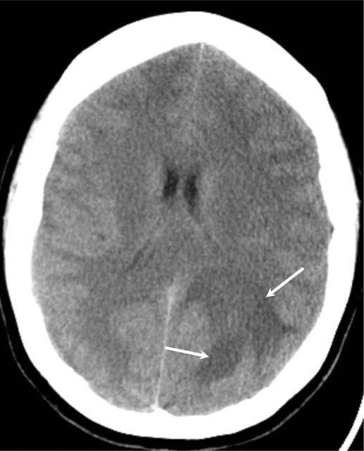NECT OF BRAIN ABCESS (EARLY CEREBITIS ) There is a poorly