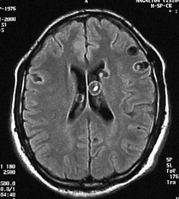 hydrocephalus caused by blockage
