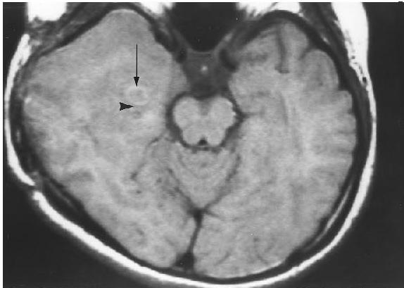 MRI T1 OF TUBERCULOMA Shows thick rim of slightly hyperintense with