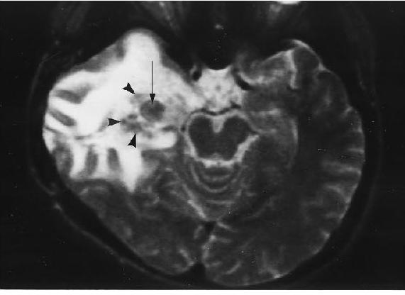 MRI T2 OF TUBERCULOMA Shows a round slightly hetergenous isointense and hypointense mass