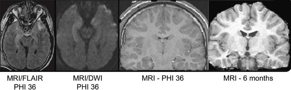 Retrospective analysis Early PTS and Epilepsy 140 patients with moderate to severe TBI, CEEG 16 patients volumetric MRI, acute and 6 months 6 patients with early seizures, 10 age- and GCS-matched