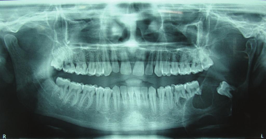Mucosa overlying the lesion was intact. The orthopantomograph revealed a multilocular radiolucency on the left side of the mandible extending from molar upto the condyle and coronoid area (Figure 2).