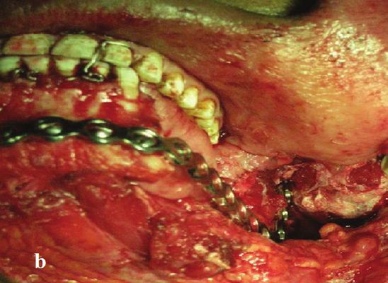 This lesion tends to occur in the canine-incisor portion in both jaws, but those in the maxilla occur more often at the anterior portion than those in the mandible [10]. Freedman et al.