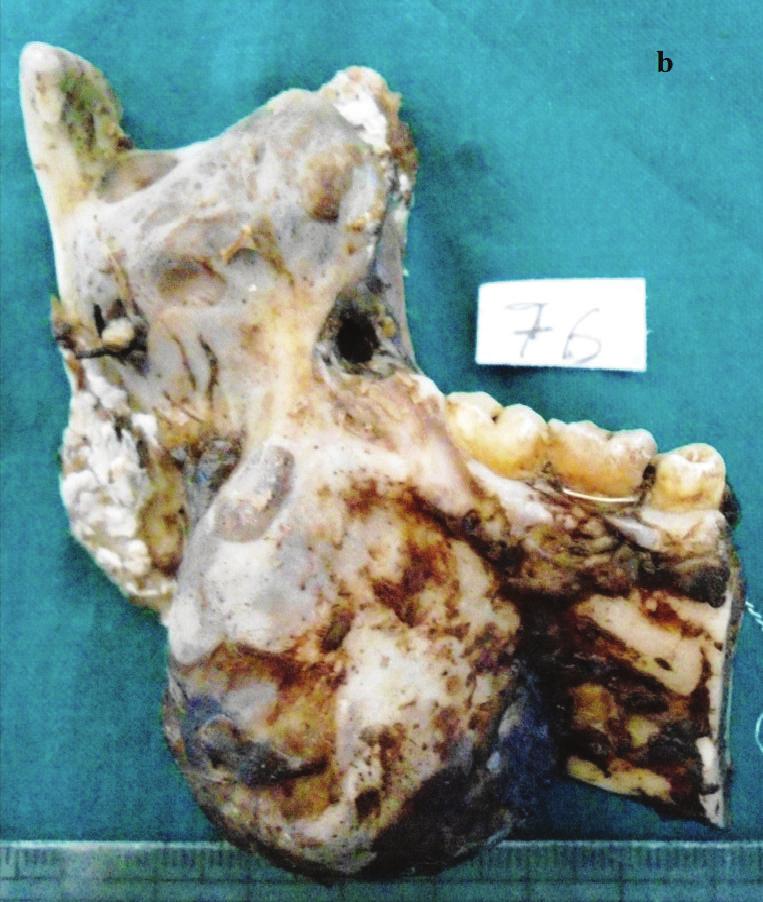 showed multilocular radiolucent lesion associated with an impacted 38 which was displaced into the ramus of the mandible, and root resorption was noted in 36 and 37.