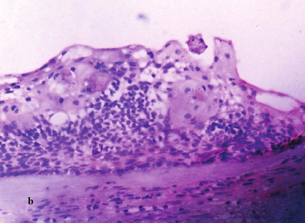 Budding from the basal layer into the adjacent connective tissue and epithelial proliferations into the lumen are frequently seen.