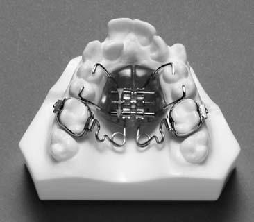 Expansion/Arch Development 9 Expansion and Arch Development is a broad term used to describe appliances designed to treat crowding, the most common type of malocclusion in mixed-dentition patients.