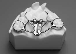 Our standard design is a two-banded style, this aids in cases with a difficult path of insertion or missing teeth.