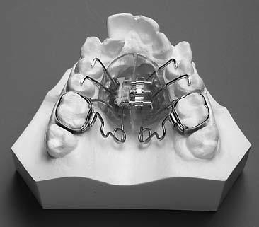 It produces orthodpedic expansion of the maxilla, as well as rotate and distalize maxillary first molars..032 TMA* springs produce light and continuous force against the molars.