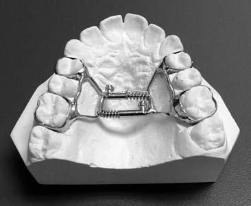 The active components of the appliance are soldered or attached to the molar bands in the same way as a traditional expander.
