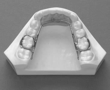 Retention is obtained by incorporating ball and adams clasps.