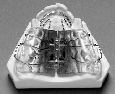 NiTi coil springs create piston-like forces to move anterior teeth forward.