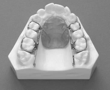 The anchoring component is secured to the bicuspids or primary molars with bands or bonding. * TMA wire is a trademark of Ormco Corporation, Glendora, CA.